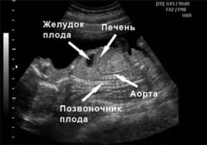 Увеличен желудок у плода