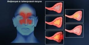 Наложения в гайморовых пазухах