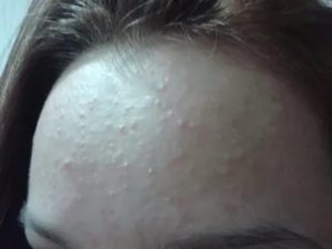 После Юнидокса вылезли мелкие прыщики