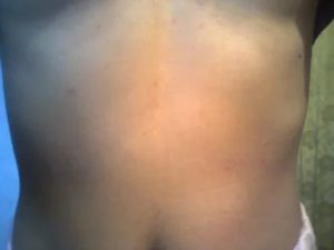 Сыпь на теле под ребрами