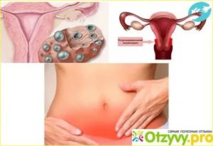 Сильная боль в левом яичнике, хотя овуляция в правом