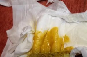 Понос у грудинка после смены смеси