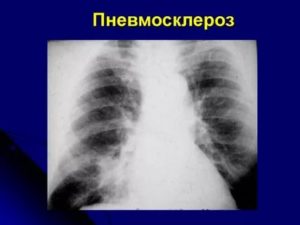 Тяжистый пневмофиброз, очаг уплотнения легочной паренхимы