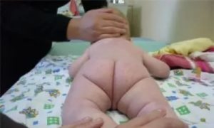 Не симметричные складки на попе