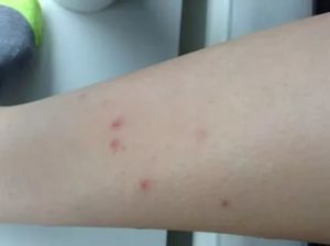 Сыпь на ноге и руке, чешется