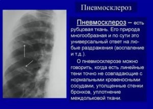 Тяжистый пневмофиброз, очаг уплотнения легочной паренхимы