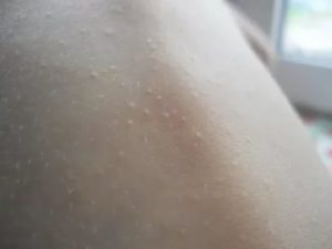 Сыпь у ребёнка телесного цвета