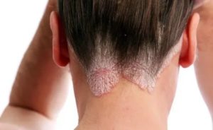 Себорейный дерматит бывает на локтях? Как его лечить?