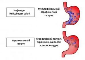 Поверхностный гастрит и сухость во рту