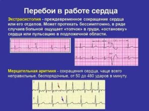 Сильные перебои в сердце