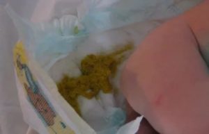 Понос у грудинка после смены смеси