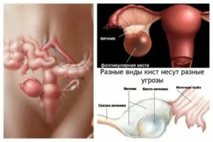 Киста левого яичника фолликулярная 5.2*5.3 см