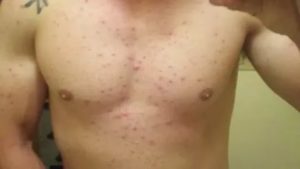 Прыщи на груди и спине на отмене преднизолона