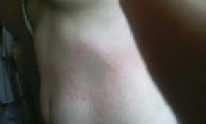 Сыпь на теле под ребрами