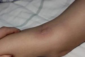 Уплотнение в голени